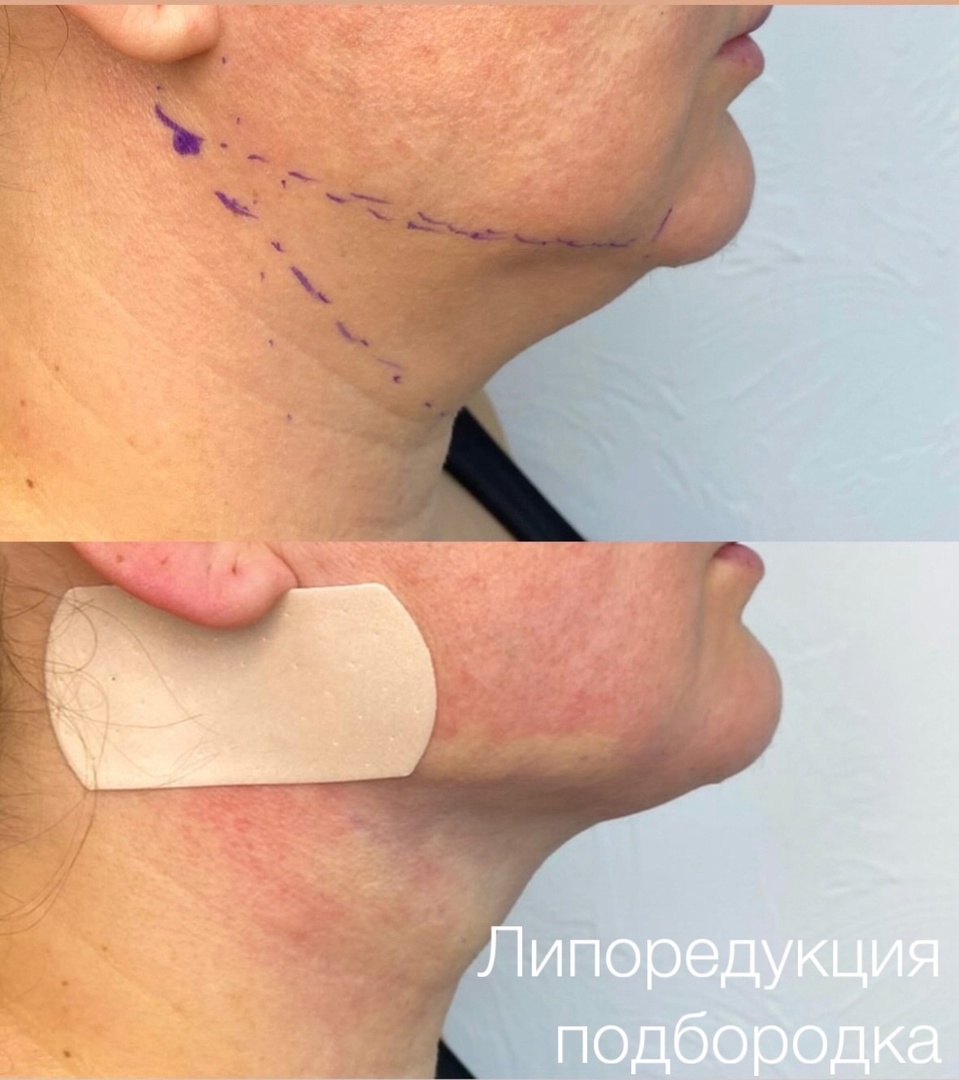 Липоредукция подбородка Липоредукция подбородка