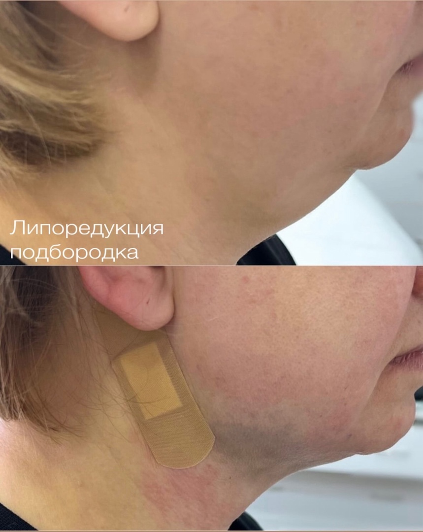 Липоредукция подбородка Липоредукция подбородка