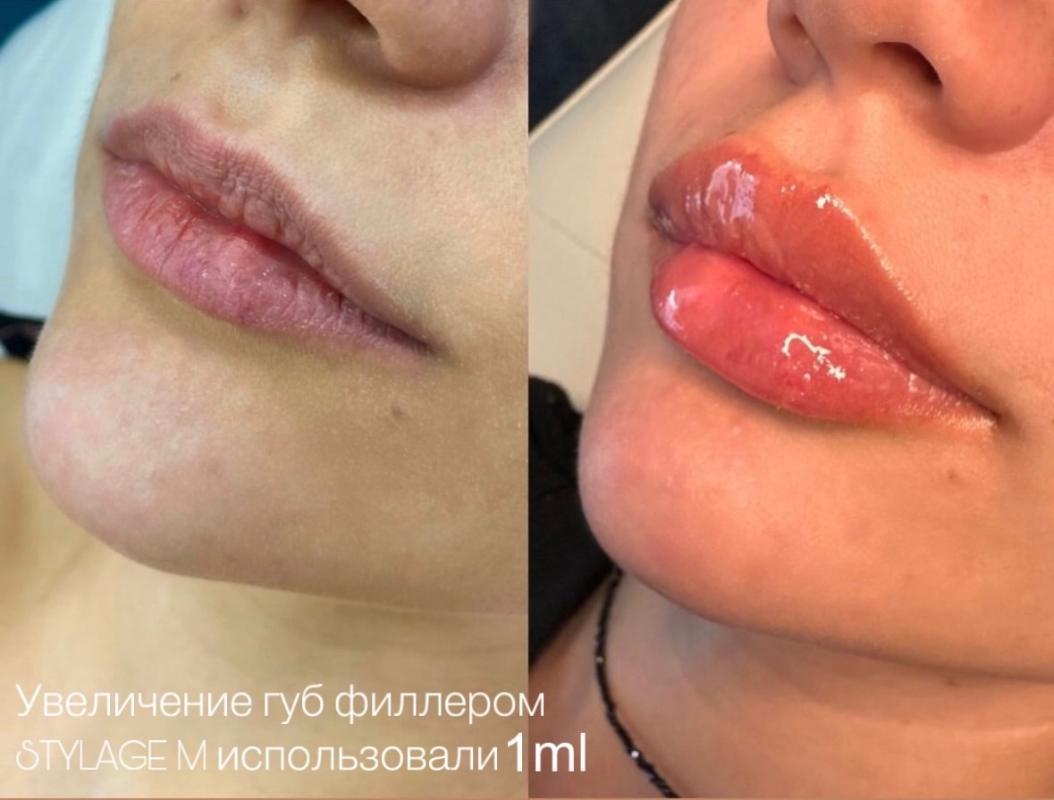 Увеличение губ до-после